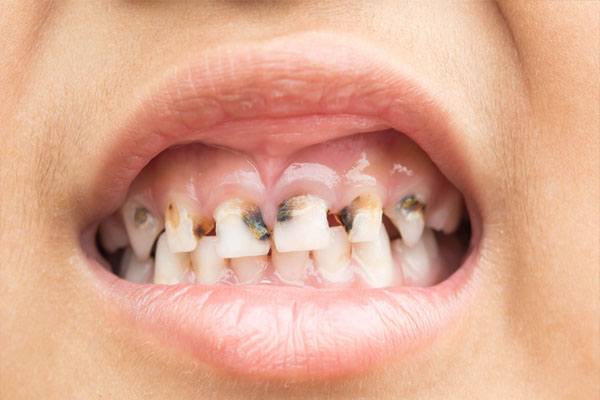 Oral Health | ಸ್ವೀಟ್ ತಿನ್ನೋದ್ರಿಂದ ಕ್ಯಾವಿಟಿ ಆಗುತ್ತಾ?